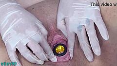 German Cervix Stretching With Catheter Inflation Uterus